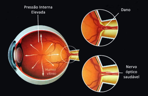 Glaucoma